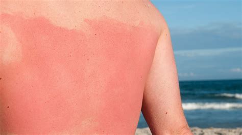 can you get a sunburn after 5pm|sunscreen at 4pm.